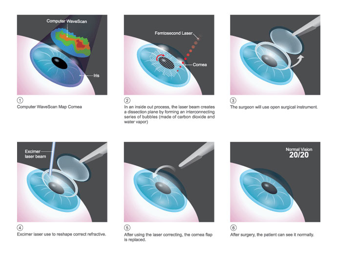 How LASIK works illustration