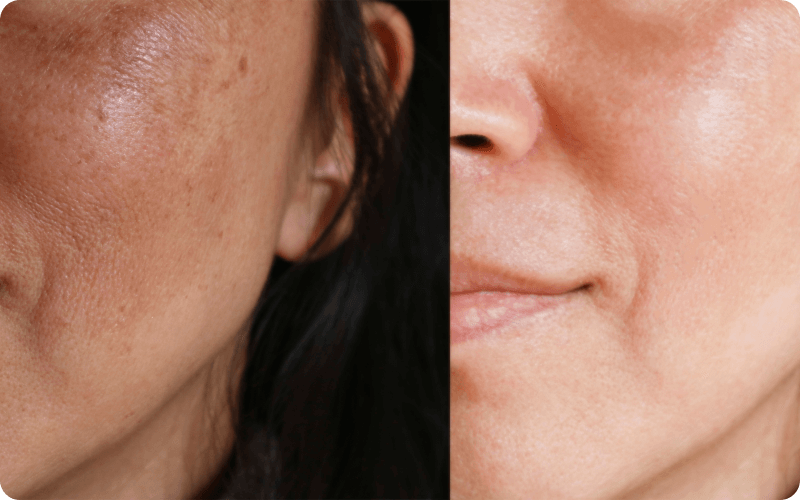 Before and after Mixto CO2 Laser Resurfacing