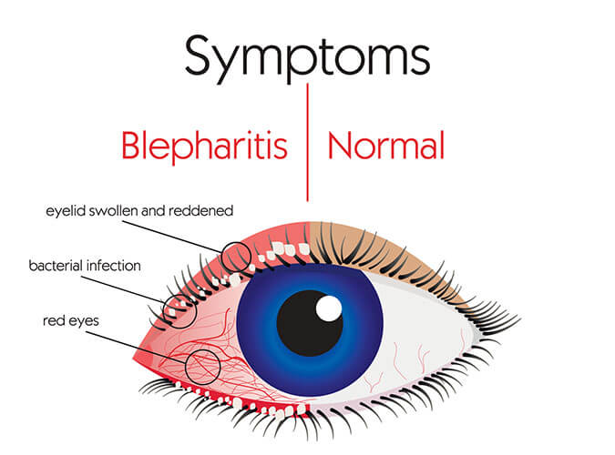 Blepharitis symptoms illustration