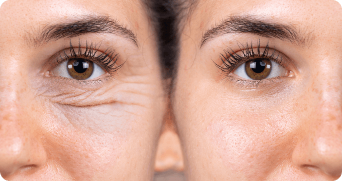 Blepharoplasty comparison before and after
