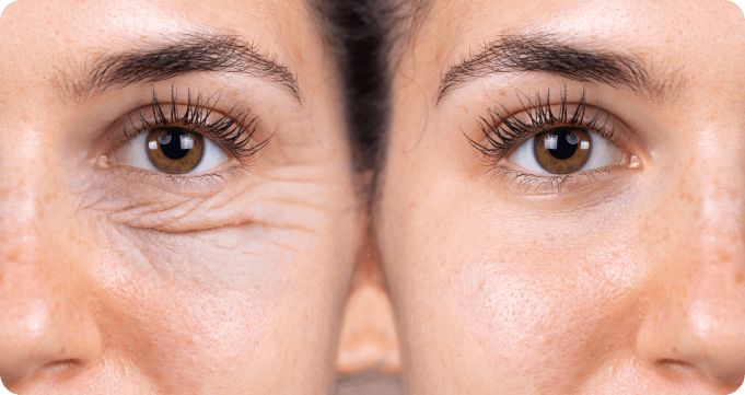 icl-img2 Blepharoplasty comparison before and after