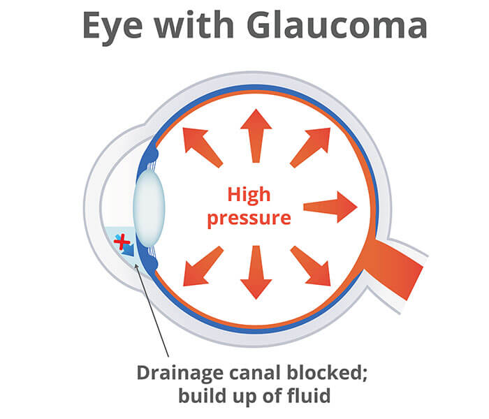 Eye with glaucoma illustration