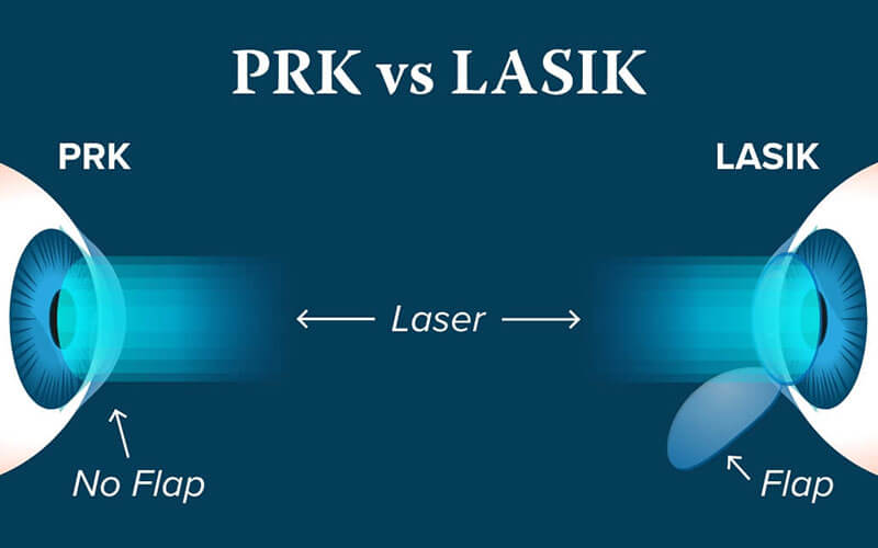 PRK vs. LASIK graphics illustration