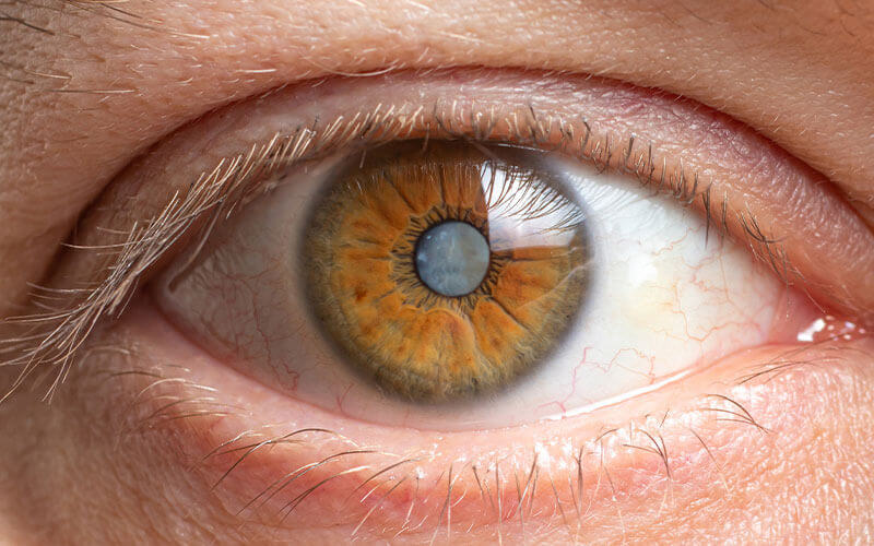 What are cataracts?