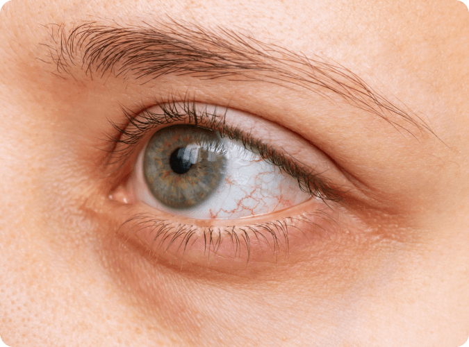 A close up of a red, irritated eye impacted by dry eye disease.