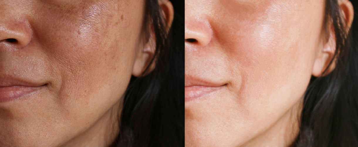 woman's smile lines removed in before and after image