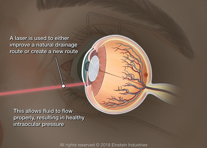 EVO Visian ICL