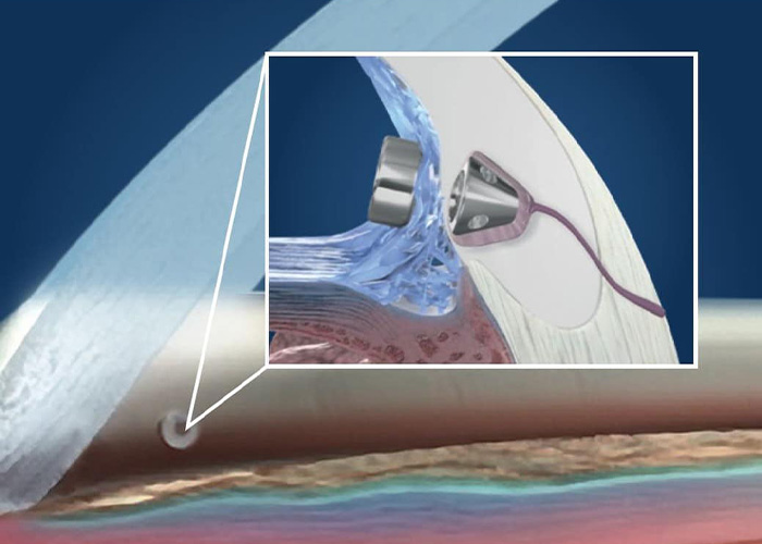 Symptoms and risk factors of cataracts illustration