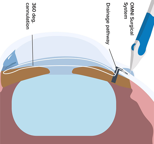 Symptoms and risk factors of cataracts illustration