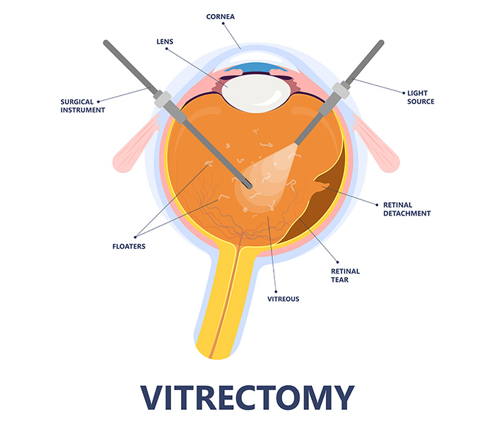What-is-laser-vitreolysis-img California LASIK & Eye staff front desk smiling