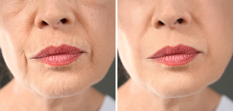 Before and after premium facial rejuvenation