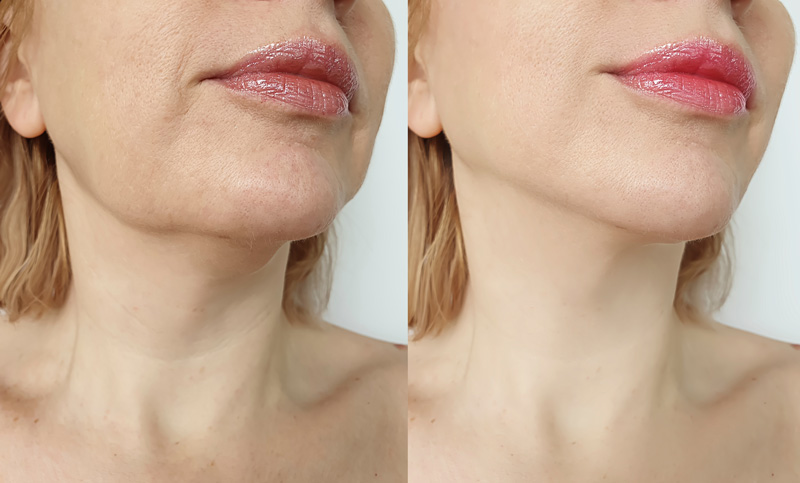 Before and after premium facial rejuvenation