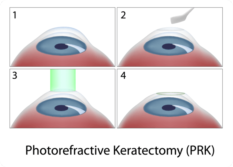 Photorefractive Keratectomy Illustration