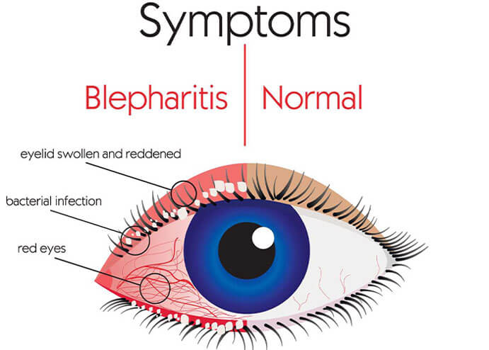 Blepharitis Symptoms illustration