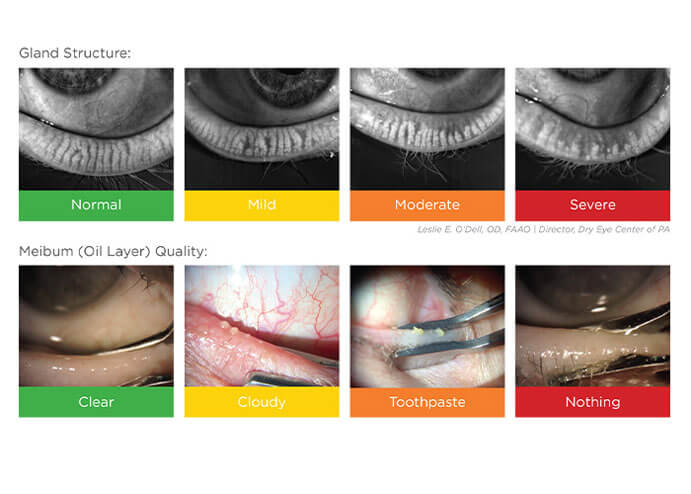 What is Blepharitis?