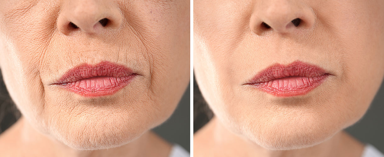 woman who had botox around her mouth