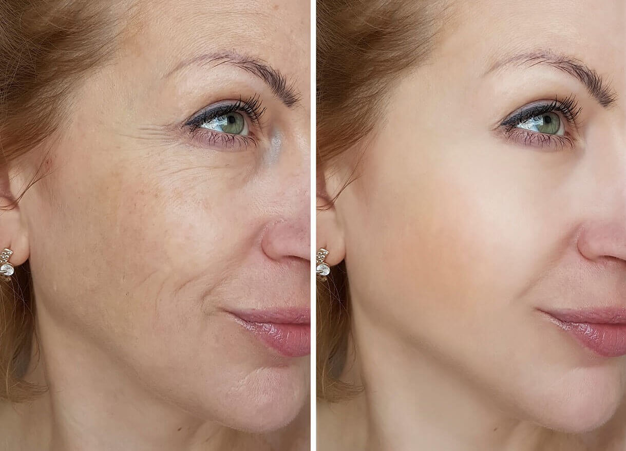 patient before and after crow's feet removal from eyes