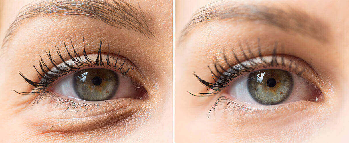 patient's eye before and after treatment