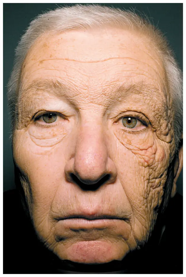 older man with sun damaged skin on half his face